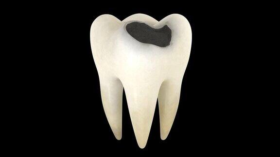 一个带有alpha层的牙齿腐烂的3D动画