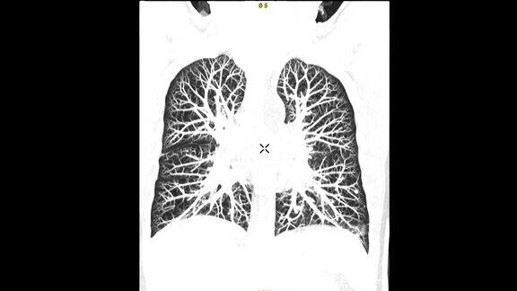 冠状位MIP影像诊断肺栓塞(PE)和肺癌