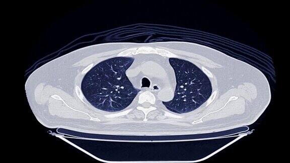 CT胸部轴向注射造影剂