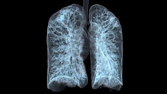 CT胸肺3D显示用于诊断结核病、结核病和covid-19