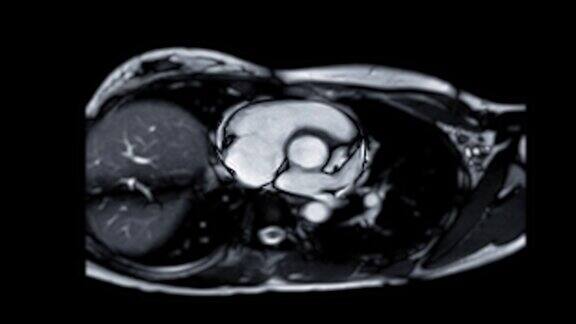 心脏核磁共振成像或心脏核磁共振成像(MRI)显示主动脉瓣检测心脏疾病