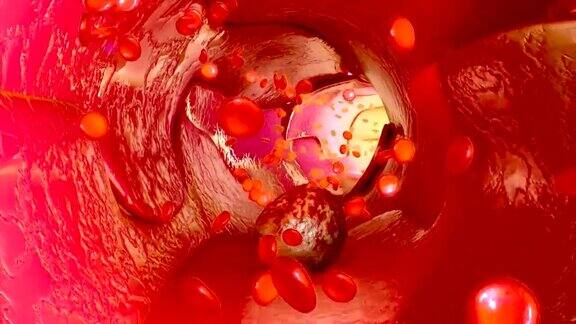 血管中的癌细胞
