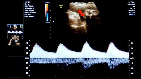 HD-医疗超声扫描心率诊断