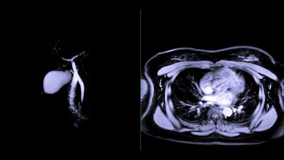 磁共振胰胆管造影或MRCP3DMIP图像比较轴向T1W后GD胆管和胰管