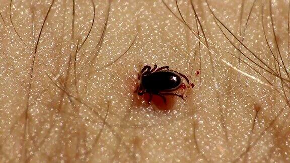 蜱虫附着在人类皮肤上以血液为食