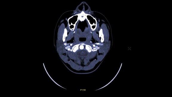 CTA脑缓慢运动或CT脑轴位扫描注射造影剂诊断动脉疾病