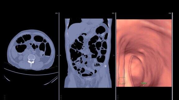 CT结肠镜