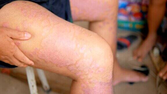 牛皮癣患者用草药来治疗自己腿上的伤口