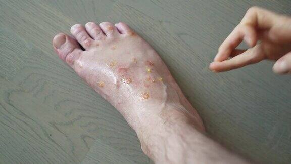 许多蚊子在腿上叮咬过敏反应皮炎女人的手正在往皮肤上涂药膏