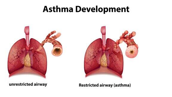 哮喘发展的动画与解释
