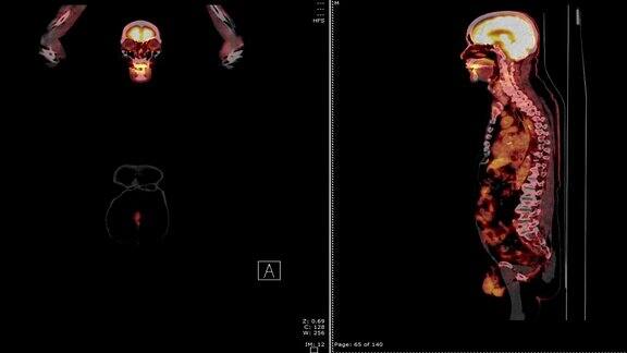 正电子发射断层扫描(PET)