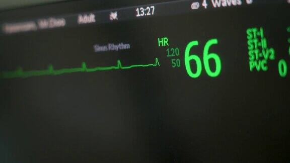 ICU监护仪上的心率