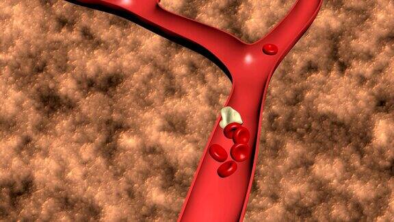 血栓形成的动画