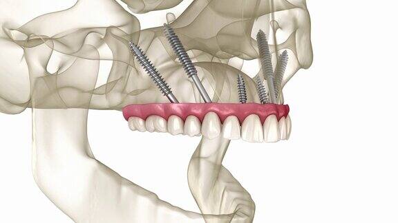 由颧种植体支撑的上颌假体医学上精确的人类牙齿和假牙的3D动画