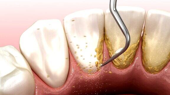口腔卫生:超声波洁牙机清除牙石和牙菌斑医学上精确的人类牙齿治疗3D动画