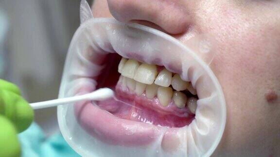 牙诊所戴着扩张器的女人在去除保护美白胶