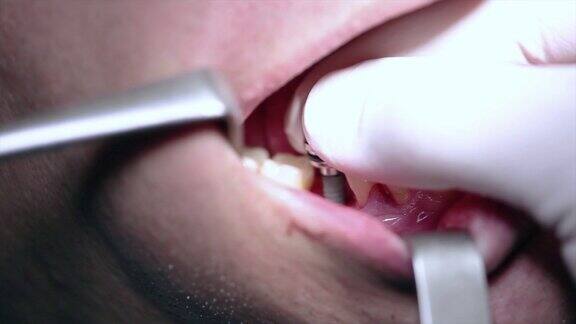 牙科植入物