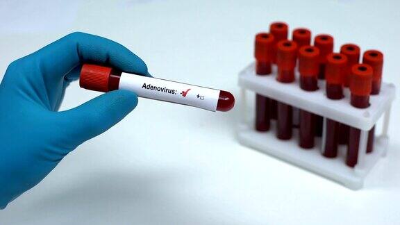 阴性腺病毒医生展示血样实验室研究保健