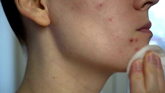 近距离观察皮肤问题(不健康的皮肤如痤疮和丘疹)治疗问题皮肤