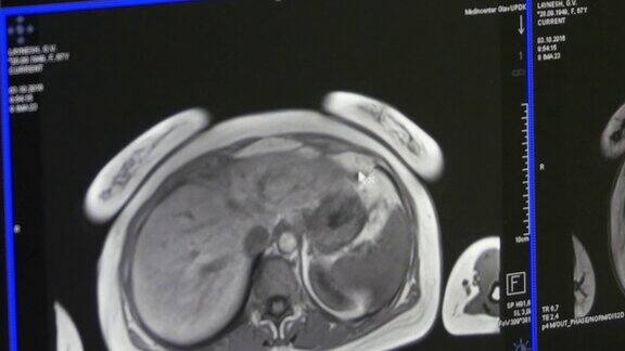 MRI脑部断层扫描