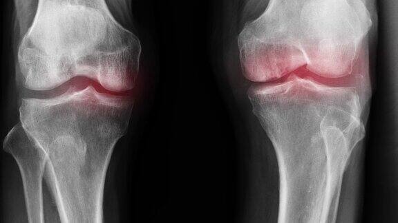 OA膝关节x线影像有近距离膝关节和红色高光
