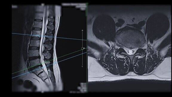 MRIL-S脊柱或腰椎矢状面T2W轴位图用于诊断脊髓受压