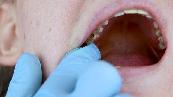 牙洞牙齿上的洞和对牙管的治疗在牙科诊所治疗牙周炎