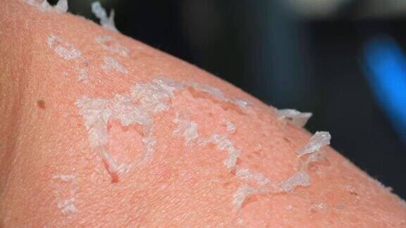晒伤背部和肩部晒伤皮肤脱皮特写在阳光下晒太阳会损害皮肤