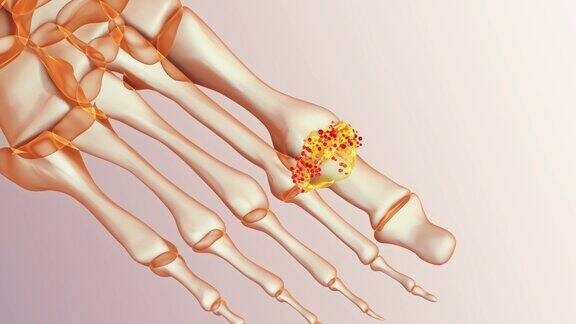 人类痛风脚趾