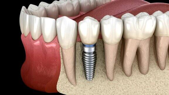 前磨牙种植修复医学上精确的人类牙齿和假牙的三维动画概念