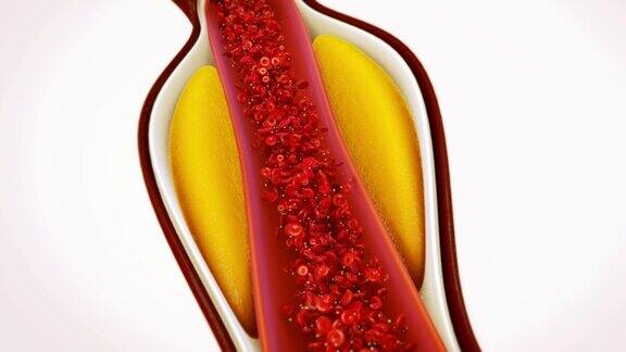 脂肪卡在血液动脉中的胆固醇