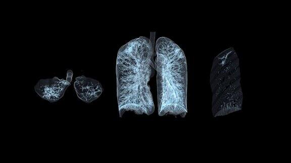 CT胸肺3D显示用于诊断结核病、结核病和covid-19