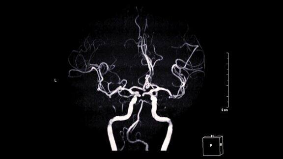 MRA脑或脑动脉磁共振血管造影