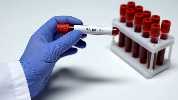 尿酸医生在试管中展示血液样本实验室研究健康检查