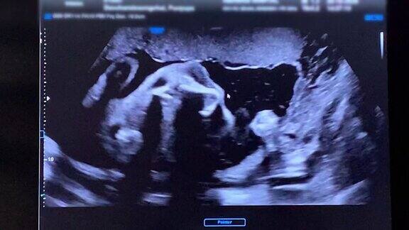 孕妇胎儿的超声扫描