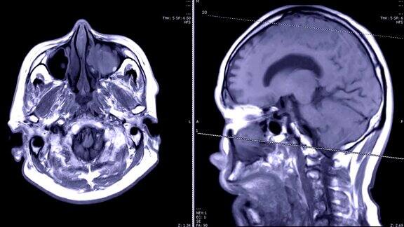 磁共振成像(MRI)的大脑轴向和矢状面造影剂