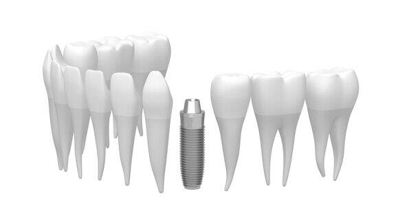 3D种植牙种植牙