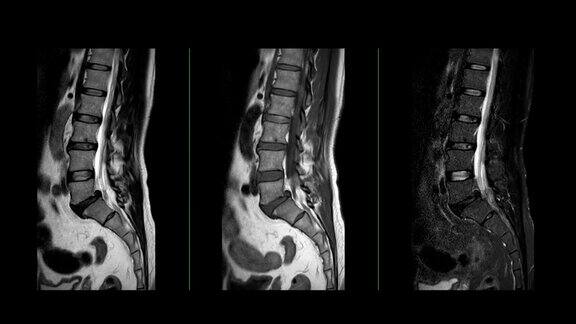 MRIL-S型脊柱或腰椎矢状T2W、T1W和T2W脂肪抑制诊断脊髓压迫