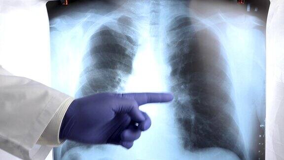 穿白大褂的医生在肺部x光片上用手指指出一些疾病肺炎和癌症