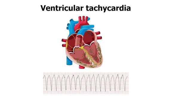 心电室性心动过速(VT)心脏动画