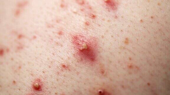 皮肤问题极近距离的皮肤痤疮和丘疹