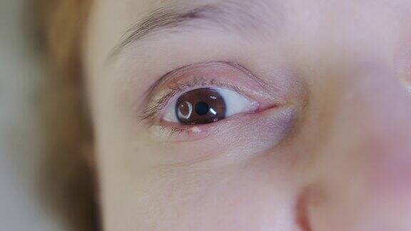 近距离观察一个女人的眼睛红眼睑伴有葡萄球菌感染