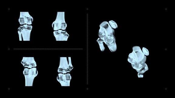 膝关节CT扫描