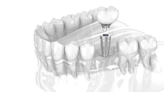 种植体及陶瓷冠人类牙齿的3D动画