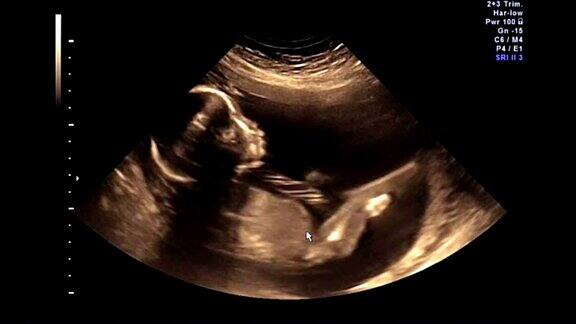 婴儿或胎儿在21周时踢的超声波