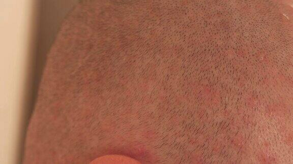 水痘带状疱疹病毒引起的水泡疹一个男人脸上有水痘的特写
