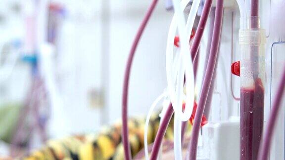 血液透析在人体上的设备