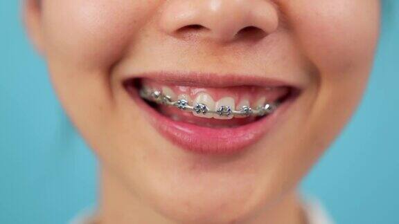 一个年轻的微笑亚洲女人的牙齿矫正矫正治疗