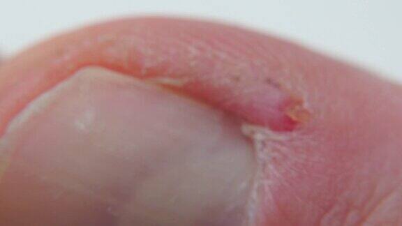 一个发炎的手指角质层的特写