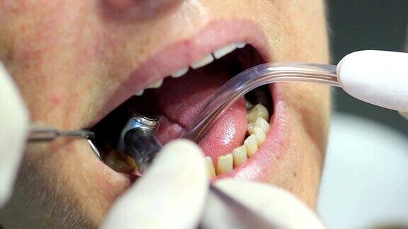 牙科医生-在口腔检查时把病人张开的嘴闭合